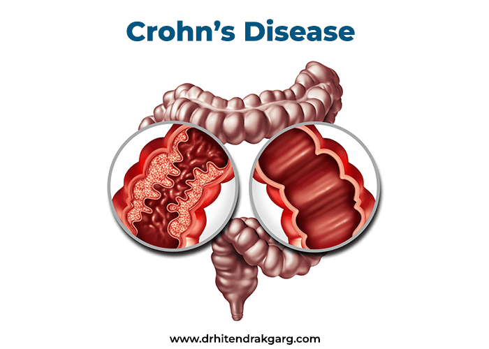 Understanding of Crohn’s Disease:
                                    Symptoms and Treatment